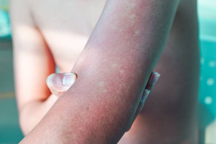 Sintomadengue_manchas-na-pele O Perigo da Dengue